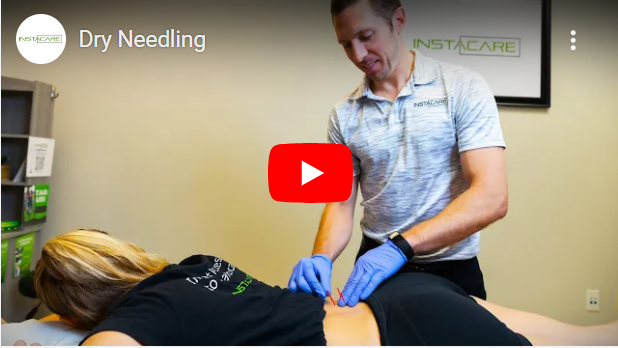 Dry Needling
